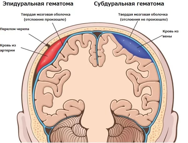 Марадону прооперируют из-за субдуральной гематомы. Что это и насколько опасно?